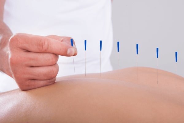 Acupuncture-for-Erectile-Dysfunction