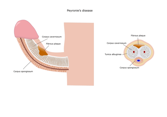 PEYRONIE's DISEASE